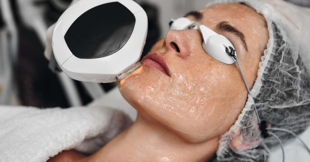 laser pigmentation removal